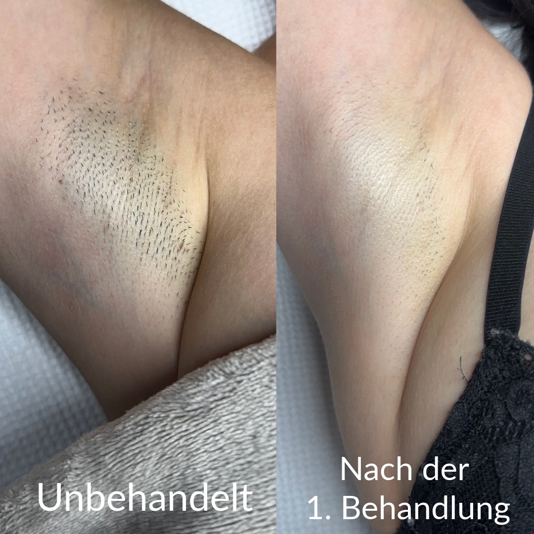 Vorher/Nachher Achseln Behandlung
