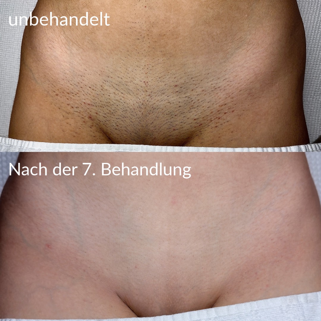 Vorher/Nachher Schambereich Behandlung 1