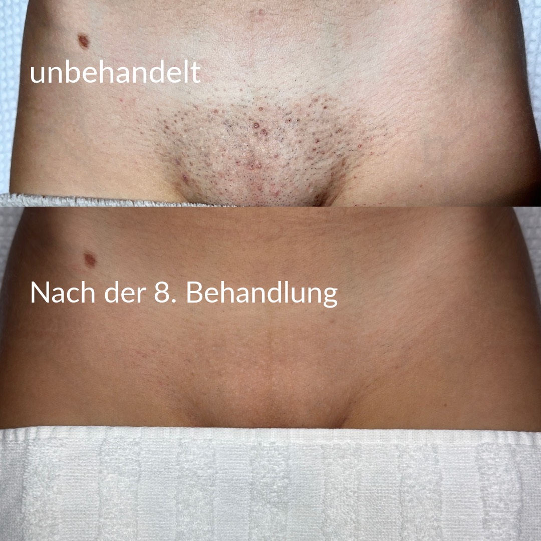 Vorher/Nachher Schambereich Behandlung 2